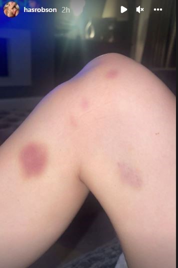 Bruises on legs